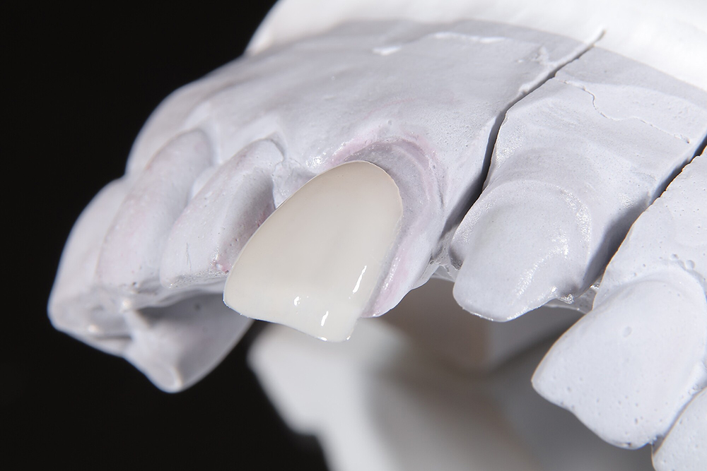 ラミネートべニア