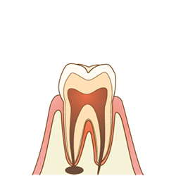 内部にある歯髄(歯の神経)まで菌に感染しています。