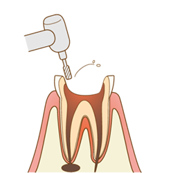 感染した部分を削っていきます。