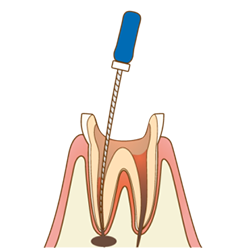 感染した歯髄や膿を除去していきます。