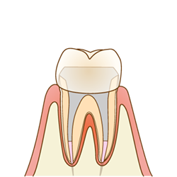 根管内の殺菌終了後、仮のかぶせ物を付けます。