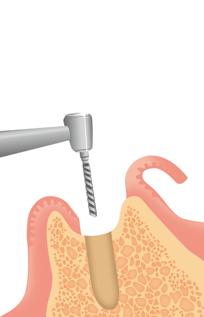 歯茎を切開して、ドリルでインプラントの器具を埋め込む穴をあけます。
