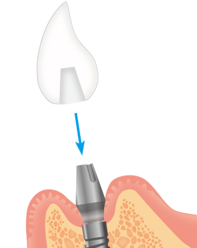 無事結合されたら、かぶせ物をアバットメントに装着します。
