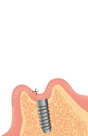インプラントの器具を埋め込み終わったら、切開した歯茎を縫い合わせます。この状態で顎の骨とインプラントの器具が結合するのを3～6カ月程度待ちます。
