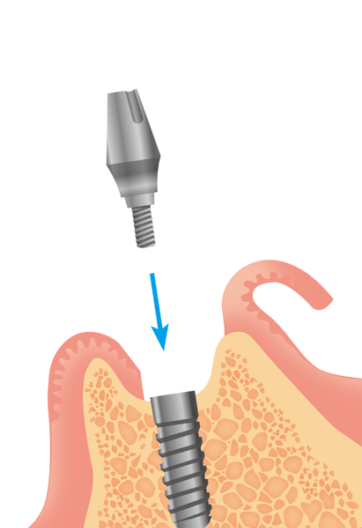 無事結合されたら、アバットメントを装着するため、歯茎を再度切開します。