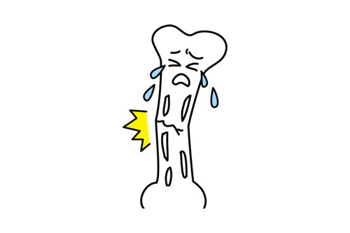 骨粗しょう症